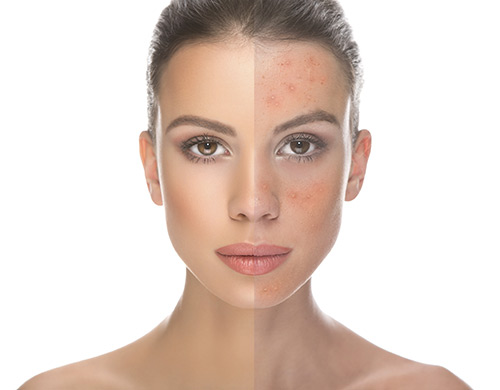 microdermabration-acne-treatment